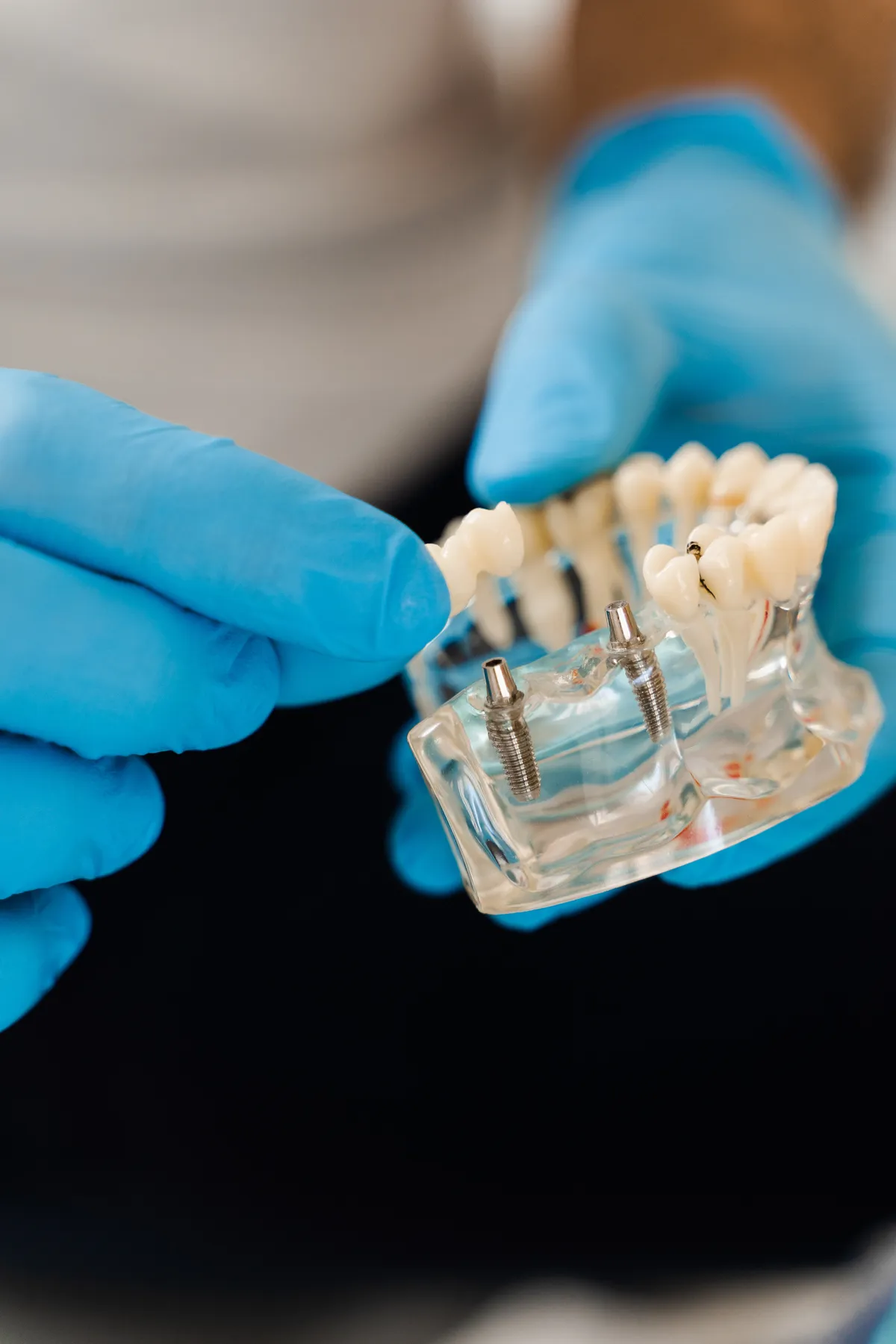 Implantes Dentários